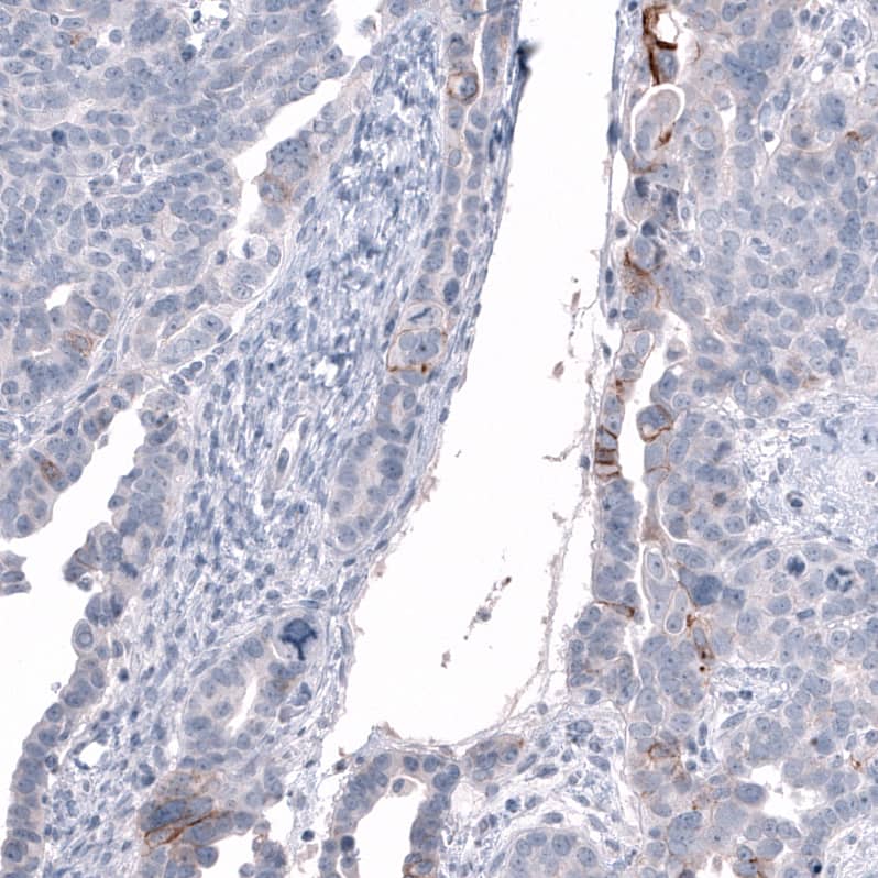 Staining of human ovarian cancer (papillary carcinoma) shows moderate membranous positivity in a subset of tumor cells.