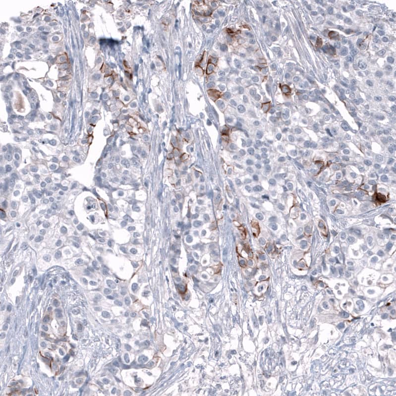 Staining of human ovarian cancer (high grade serous carcinoma) shows moderate membranous positivity in a subset of tumor cells.