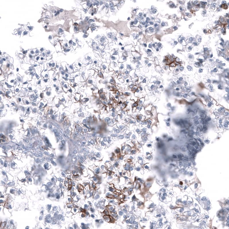 Staining of human ovarian cancer (clear cell carcinoma) shows moderate membranous positivity in tumor cells.