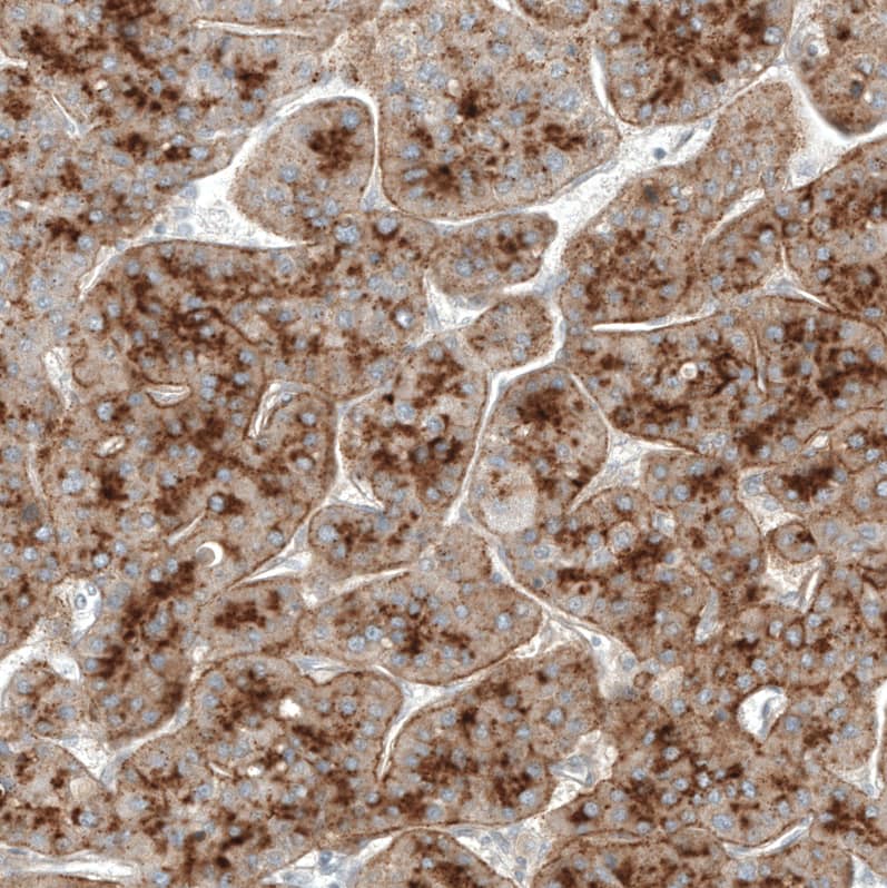 Staining of human liver cancer (hepatocellular carcinoma) shows moderate membranous positivity in tumor cells.