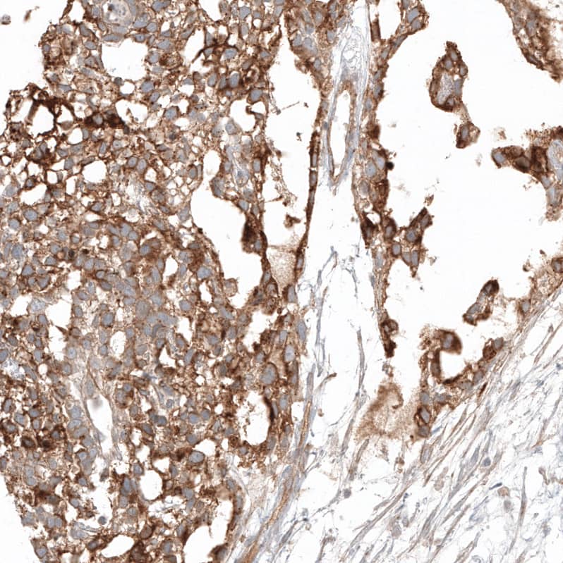 Staining of human ovarian cancer (yolk sack tumor) shows moderate membranous positivity in tumor cells.
