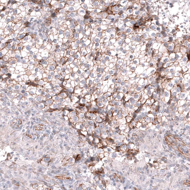 Staining of human testis cancer (seminoma) shows moderate membranous positivity in tumor cells.