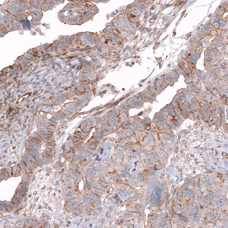 Staining of human ovarian cancer (papillary carcinoma) shows moderate membranous positivity in tumor cells.