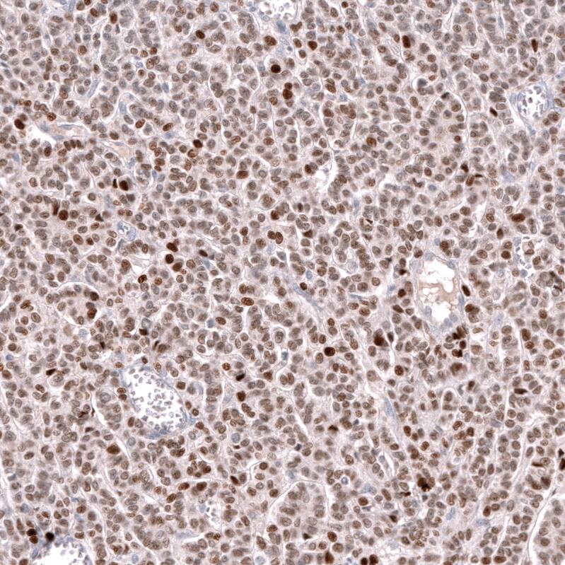 Staining of human ovarian cancer (granulosa cell tumor) shows moderate to strong nuclear positivity in tumor cells.