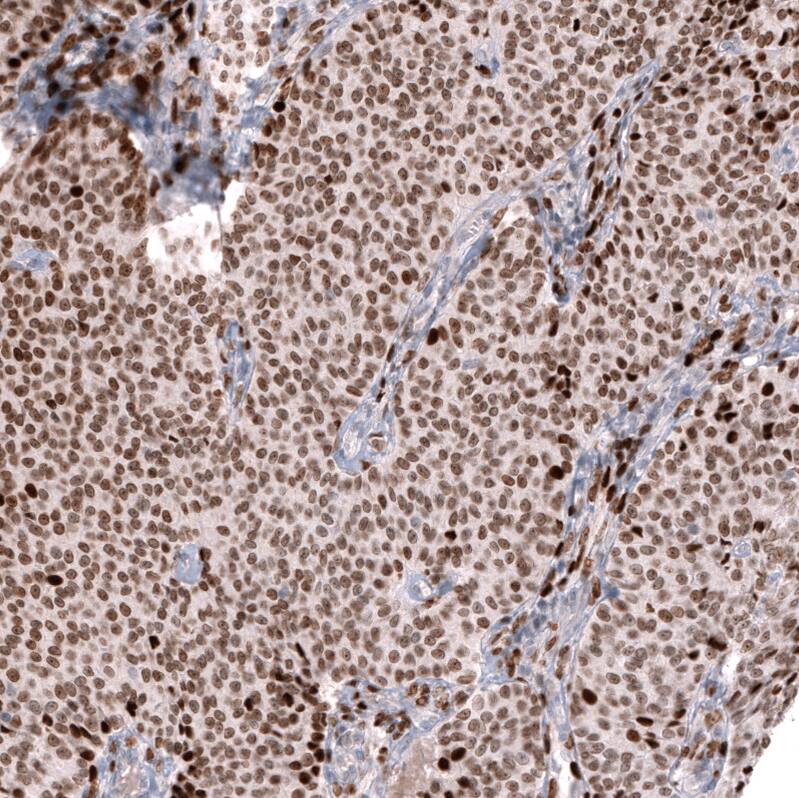 Staining of human ovarian cancer (sex cord tumor) shows moderate nuclear positivity in tumor cells.