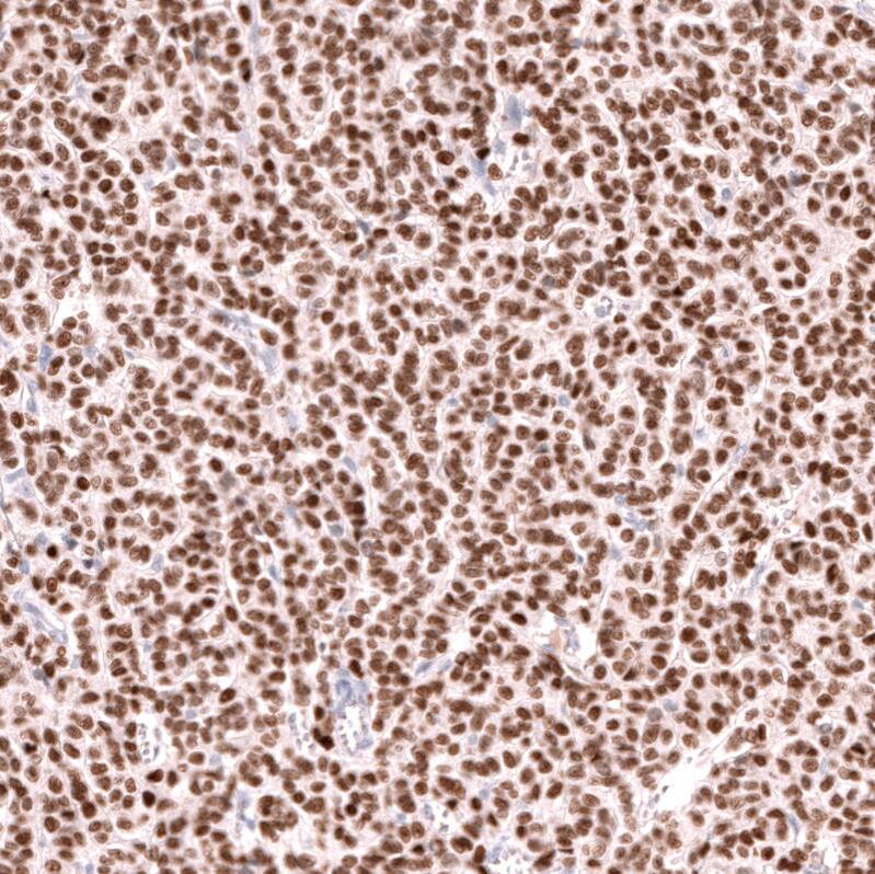 Staining of human ovarian cancer (granulosa cell tumour) shows strong nuclear positivity in tumor cells.