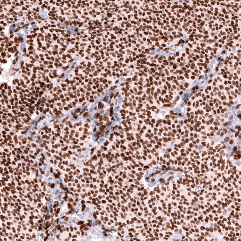 Staining of human ovarian cancer (sex cord tumor) shows strong nuclear positivity in tumor cells.
