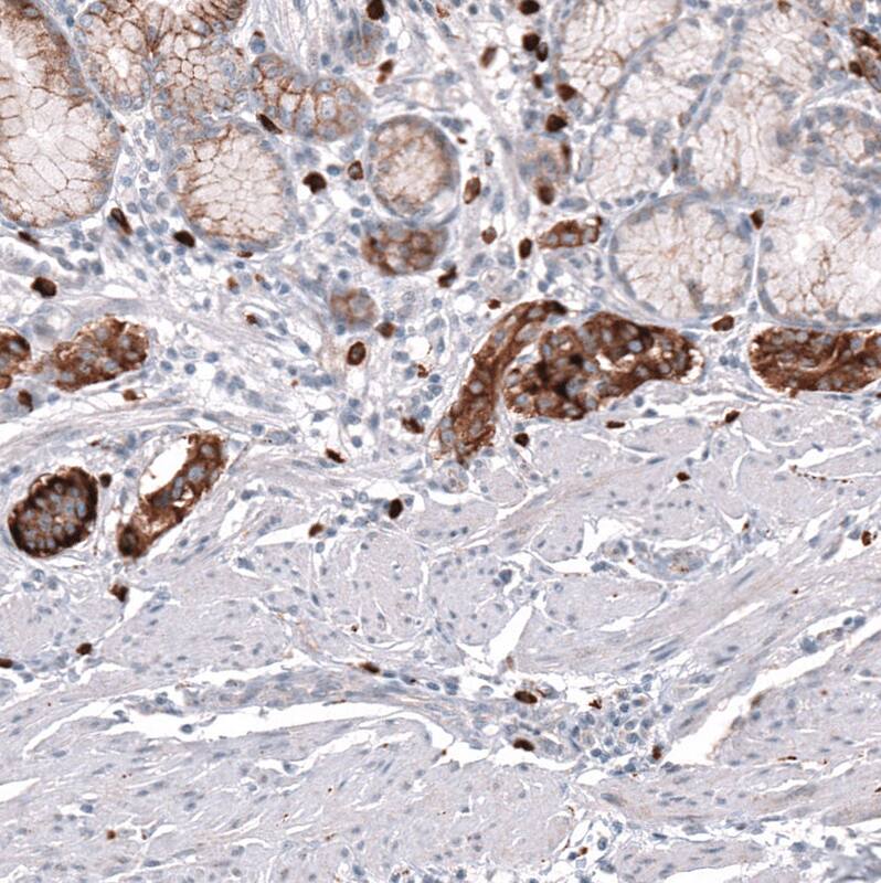 Staining of human stomach tumor (enterochromaffin-like cell carcinoid) shows strong cytoplasmic positivity in tumor cells.