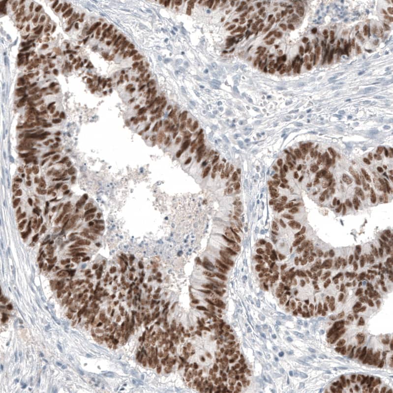 Staining of human colorectal cancer shows strong nuclear positivity in tumor cells.
