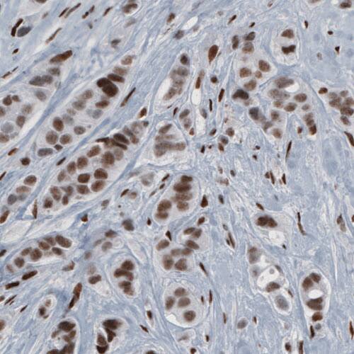 Staining of human breast cancer shows nuclear positivity in tumour cells.