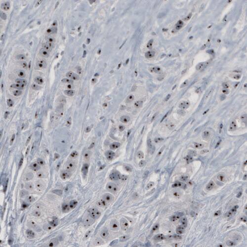 Staining of human breast cancer shows strong nucleolar positivity in tumor cells.