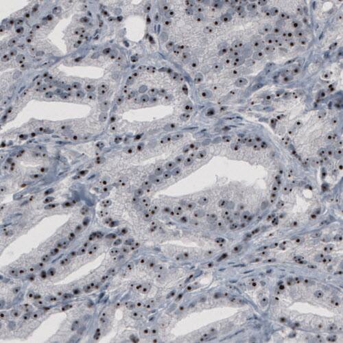 Staining of human prostate cancer shows strong nucleolar positivity in glandular cells.