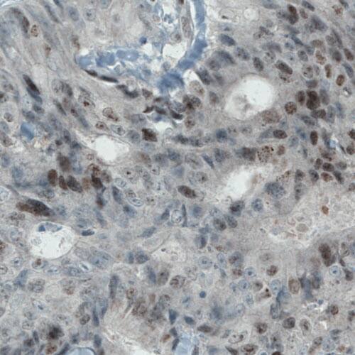 Staining of human colorectal cancer shows positivity in a subset of tumor cells.