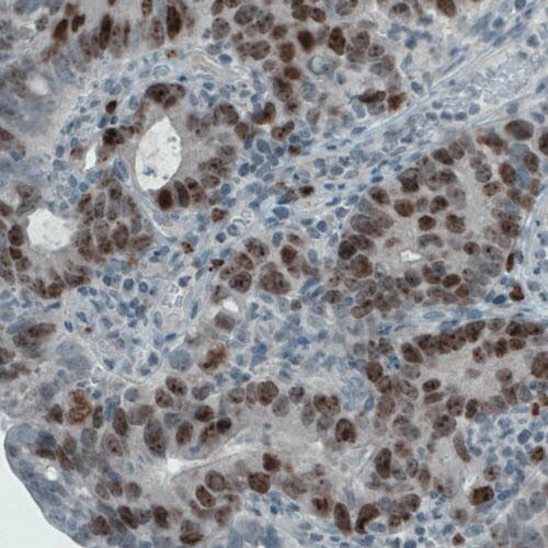 Staining of stomach cancer shows nuclear and nucleolar immunoreactivity in tumor cells.