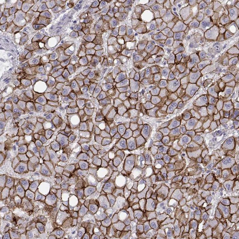 Staining of human liver cancer (hepatocellular carcinoma) shows moderate to strong membranous positivity in tumor cells.