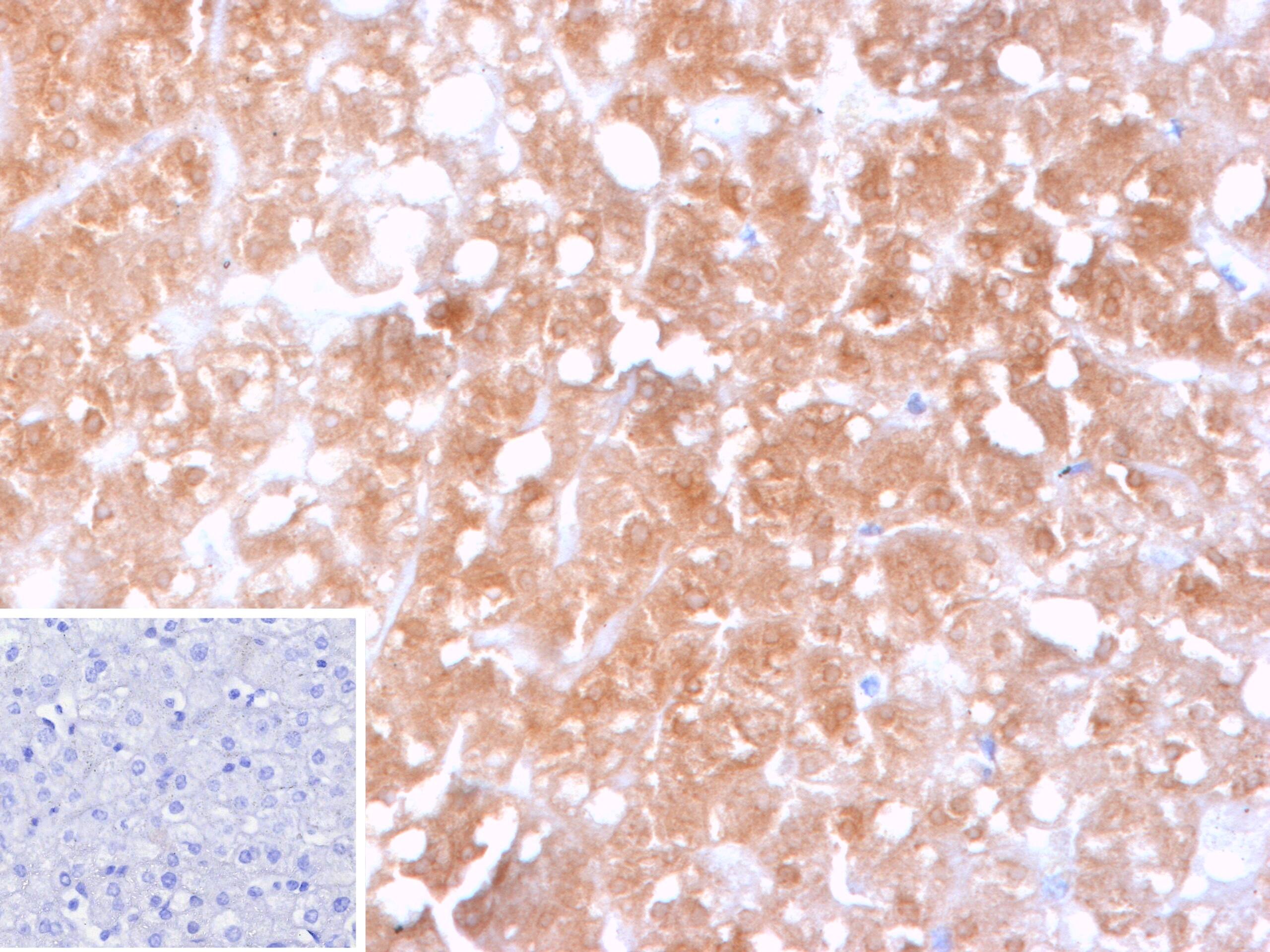Formalin-fixed, paraffin-embedded human hepatocellular carcinoma (HCC) stained with Cytochrome P450 2C9 Antibody (CYP2C9/13121). Inset: PBS instead of primary antibody; secondary only negative control.