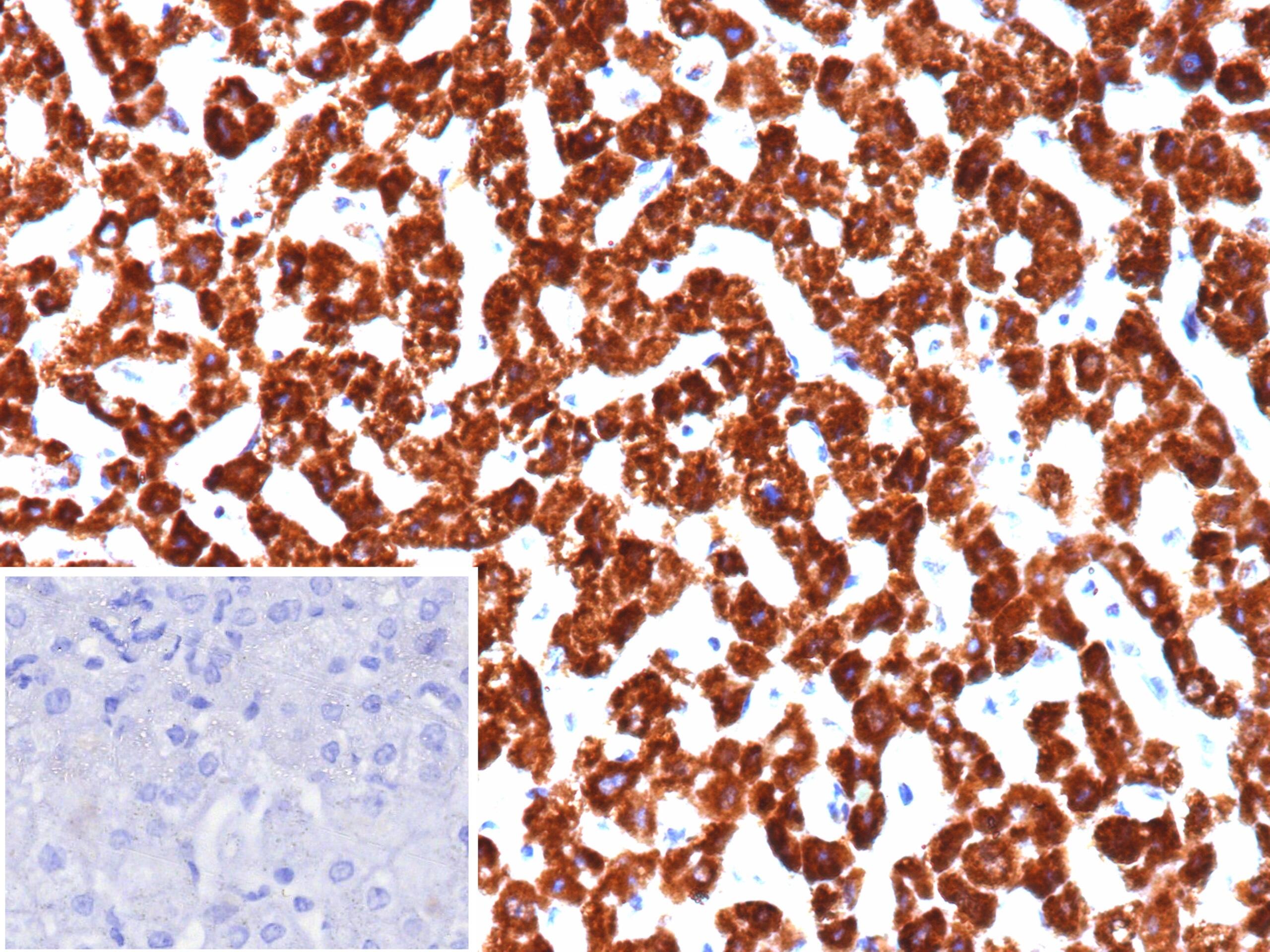 Formalin-fixed, paraffin-embedded human hepatocellular carcinoma stained with PHPT1 Antibody (PHPT1/12054). Inset: PBS instead of primary antibody; secondary only negative control.