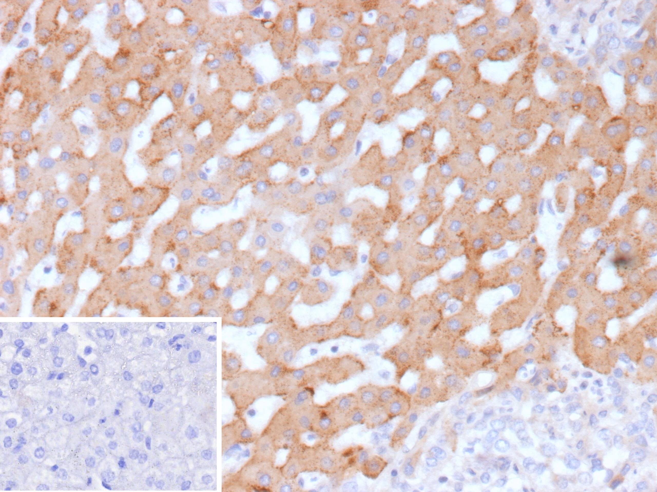 Formalin-fixed, paraffin-embedded human hepatocellular carcinoma stained with HSD17B13 Antibody (HSD17B13/13101). Inset: PBS instead of primary antibody; secondary only negative control.