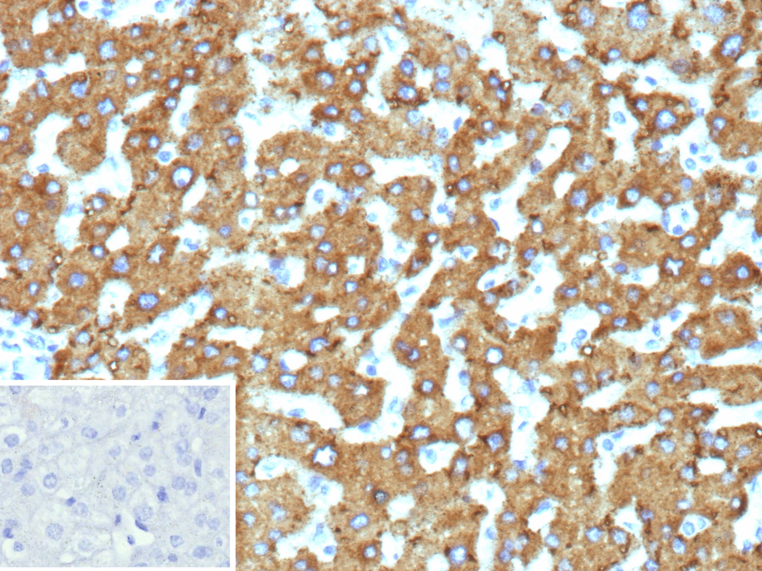 Formalin-fixed, paraffin-embedded human hepatocellular carcinoma stained with HSD17B13 Antibody (HSD17B13/13104). Inset: PBS instead of primary antibody; secondary only negative control.