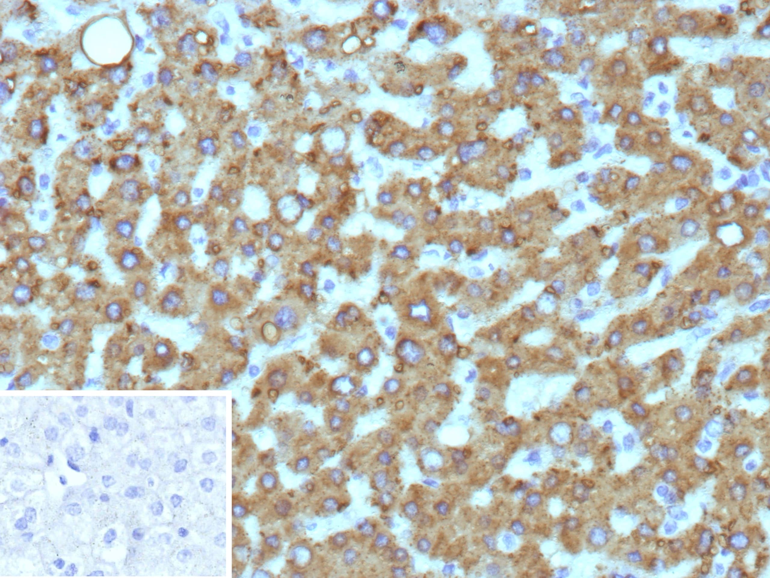 Formalin-fixed, paraffin-embedded human hepatocellular carcinoma stained with HSD17B13 Antibody (HSD17B13/13106). Inset: PBS instead of primary antibody; secondary only negative control.