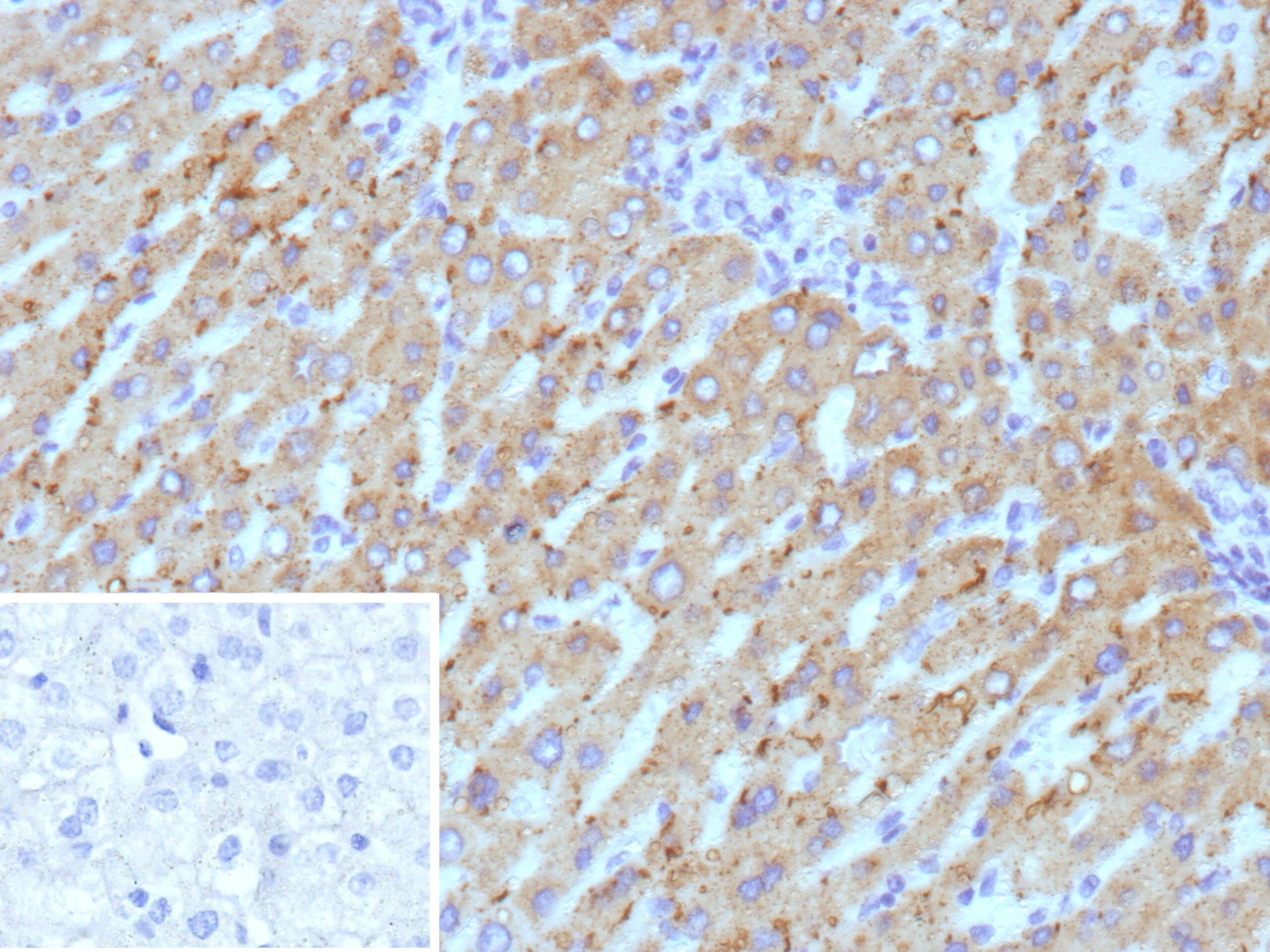 Formalin-fixed, paraffin-embedded human hepatocellular carcinoma stained with HSD17B13 Antibody (HSD17B13/13108). Inset: PBS instead of primary antibody; secondary only negative control.