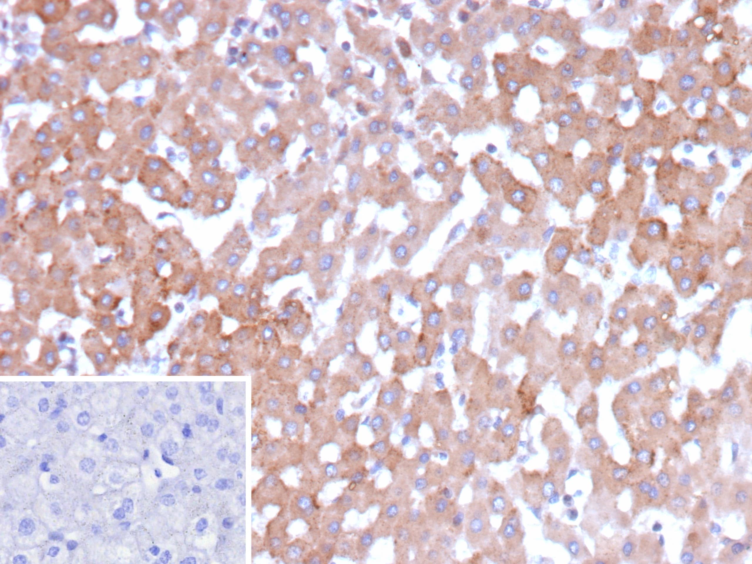 Formalin-fixed, paraffin-embedded human hepatocellular carcinoma stained with HSD17B13 Antibody (HSD17B13/13109). Inset: PBS instead of primary antibody; secondary only negative control.