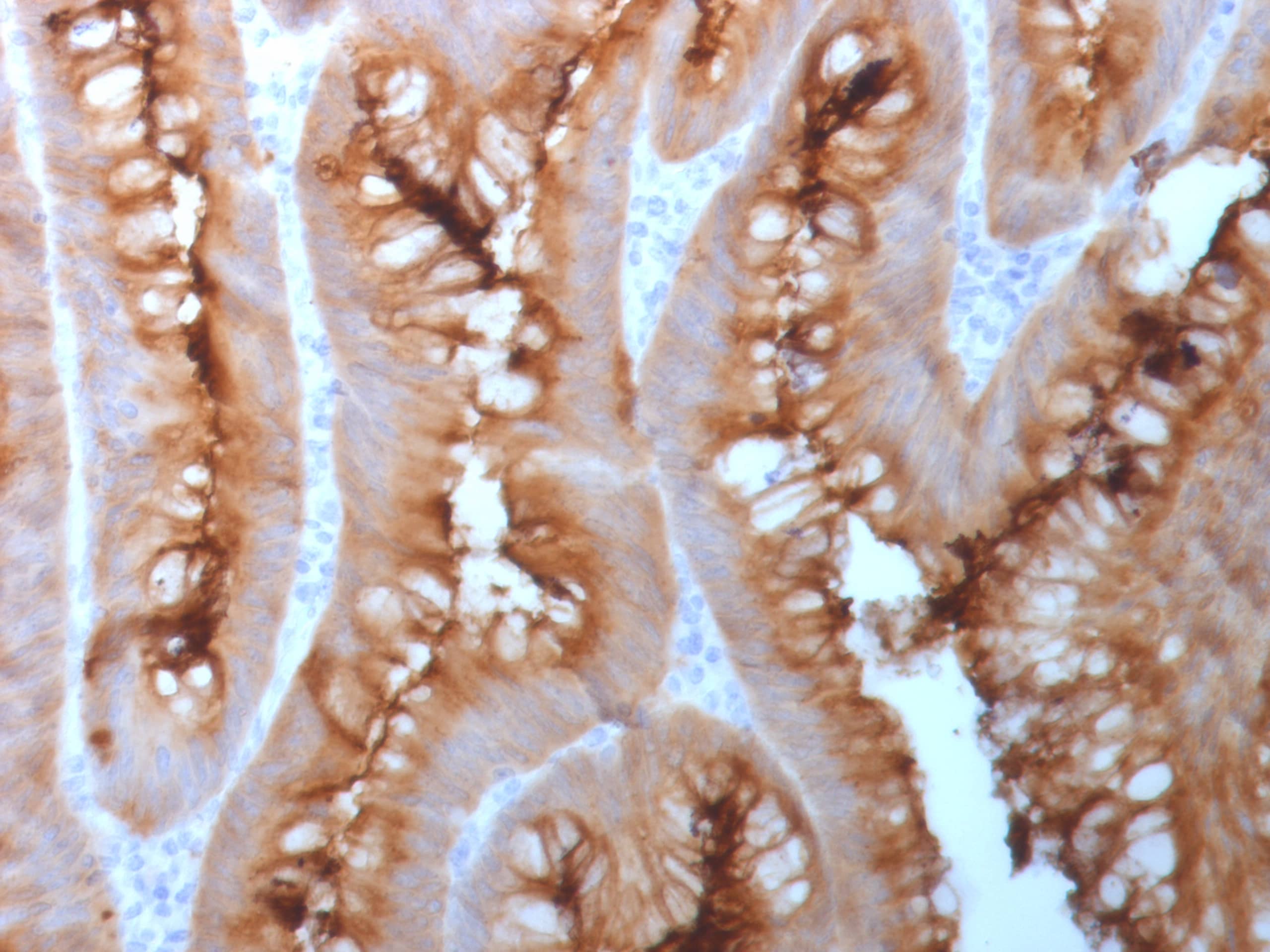 Formalin-fixed, paraffin-embedded human colon carcinoma stained with CEACAM5/CD66e Antibody (C66/1983R).