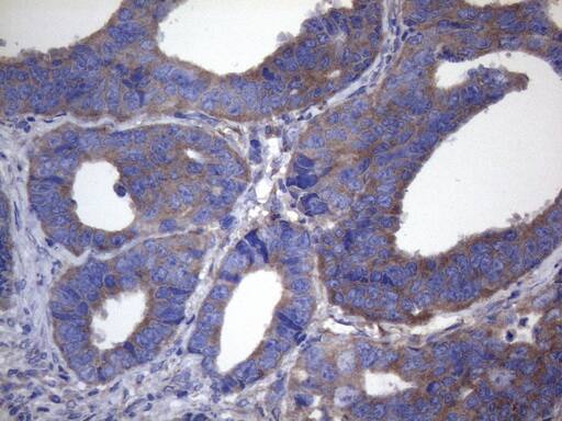 Immunohistochemical staining of paraffin-embedded Adenocarcinoma of Human colon tissue using anti-CYTH2 mouse monoclonal antibody. Heat-induced epitope retrieval by EDTA solution buffer pH 8.0 at 120Â°C for 3 min.