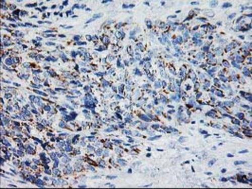 Immunohistochemical staining of paraffin-embedded Adenocarcinoma of Human colon tissue using anti-XPNPEP3 mouse monoclonal antibody. Heat-induced epitope retrieval by EDTA solution buffer pH 8.0 at 120Â°C for 3 min.