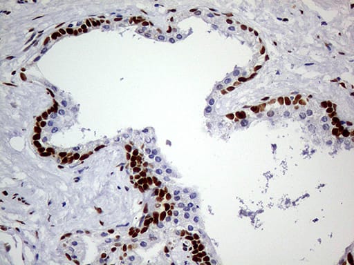 Immunohistochemical staining of paraffin-embedded Carcinoma of Human prostate tissue using anti-MEIS1 mouse monoclonal antibody. Heat-induced epitope retrieval by EDTA solution buffer pH 8.0 at 120Â°C for 3 min.
