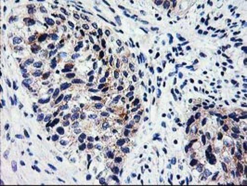 Immunohistochemical staining of paraffin-embedded Carcinoma of Human bladder tissue using anti-XPNPEP3 mouse monoclonal antibody. Heat-induced epitope retrieval by EDTA solution buffer pH 8.0 at 120Â°C for 3 min.