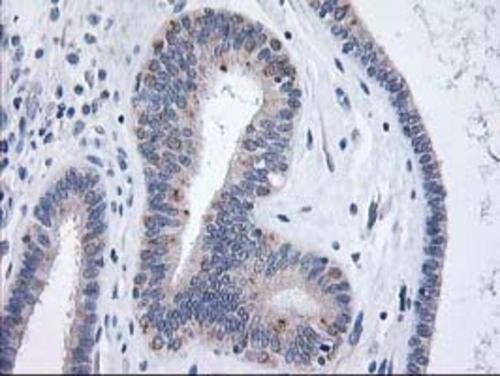Immunohistochemical staining of paraffin-embedded Adenocarcinoma of Human endometrium tissue using anti-XPNPEP3 mouse monoclonal antibody. Heat-induced epitope retrieval by EDTA solution buffer pH 8.0 at 120Â°C for 3 min.