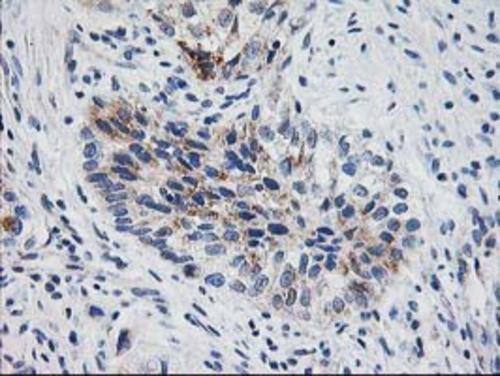 Immunohistochemical staining of paraffin-embedded Carcinoma of Human bladder tissue using anti-XPNPEP3 mouse monoclonal antibody. Heat-induced epitope retrieval by EDTA solution buffer pH 8.0 at 120Â°C for 3 min.