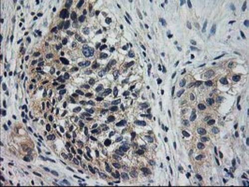 Immunohistochemical staining of paraffin-embedded Carcinoma of Human bladder tissue using anti-XPNPEP3 mouse monoclonal antibody. Heat-induced epitope retrieval by EDTA solution buffer pH 8.0 at 120Â°C for 3 min.