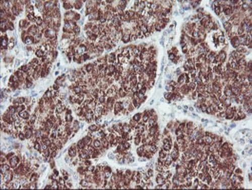 Immunohistochemical staining of paraffin-embedded Carcinoma of Human liver tissue using anti-PECI mouse monoclonal antibody. Heat-induced epitope retrieval by EDTA solution buffer pH 8.0 at 120Â°C for 3 min.