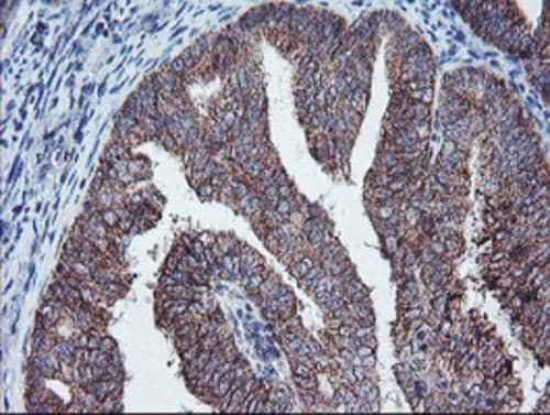 Immunohistochemical staining of paraffin-embedded Adenocarcinoma of Human endometrium tissue using anti-PECI mouse monoclonal antibody. Heat-induced epitope retrieval by EDTA solution buffer pH 8.0 at 120Â°C for 3 min.