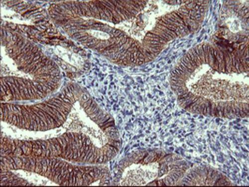 Immunohistochemical staining of paraffin-embedded Adenocarcinoma of Human endometrium tissue using anti-TH mouse monoclonal antibody. . Heat-induced epitope retrieval by EDTA solution buffer pH 8.0 at 120Â°C for 3 min.
