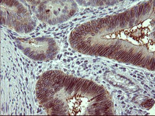 Immunohistochemical staining of paraffin-embedded Carcinoma of Human pancreas tissue using anti-TH mouse monoclonal antibody. . Heat-induced epitope retrieval by EDTA solution buffer pH 8.0 at 120Â°C for 3 min.