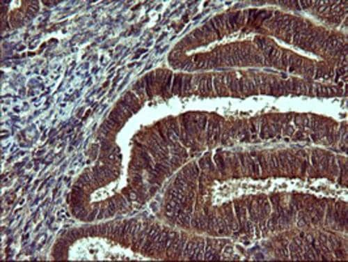 Immunohistochemical staining of paraffin-embedded Adenocarcinoma of Human endometrium tissue using anti-TUBB2A mouse monoclonal antibody. . Heat-induced epitope retrieval by EDTA solution buffer pH 8.0 at 120Â°C for 3 min.