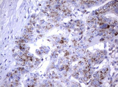Immunohistochemical staining of paraffin-embedded Carcinoma of Human liver tissue using anti-NEU1 mouse monoclonal antibody. Heat-induced epitope retrieval by EDTA solution buffer pH 8.0 at 120Â°C for 3 min.