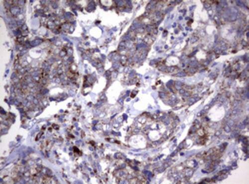 Immunohistochemical staining of paraffin-embedded Adenocarcinoma of Human breast tissue using anti-NEU1 mouse monoclonal antibody. Heat-induced epitope retrieval by EDTA solution buffer pH 8.0 at 120Â°C for 3 min.