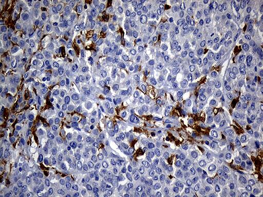 Immunohistochemical staining of paraffin-embedded Adenocarcinoma of Human breast tissue tissue using anti-UBE3B mouse monoclonal antibody. Heat-induced epitope retrieval by EDTA solution buffer pH 8.0 at 120Â°C for 3 min.