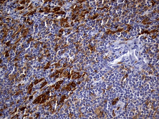 Immunohistochemical staining of paraffin-embedded Carcinoma of Human thyroid tissue using anti-UBE3B mouse monoclonal antibody. Heat-induced epitope retrieval by EDTA solution buffer pH 8.0 at 120Â°C for 3 min.