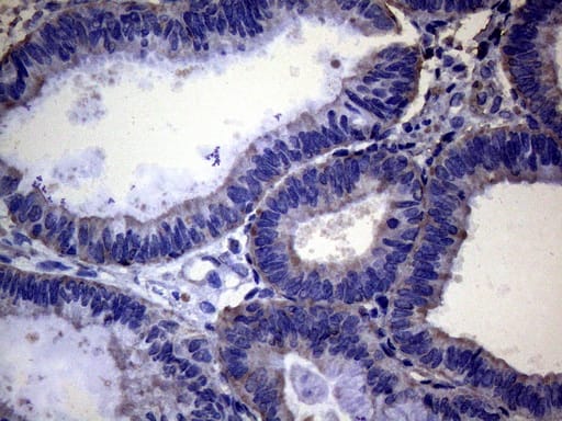 Immunohistochemical staining of paraffin-embedded Adenocarcinoma of Human endometrium tissue using anti-PAPSS2 mouse monoclonal antibody. Heat-induced epitope retrieval by EDTA solution buffer pH 8.0 at 120Â°C for 3 min.