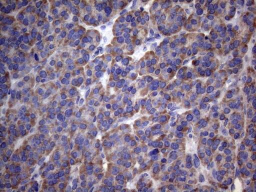 Immunohistochemical staining of paraffin-embedded Carcinoma of Human thyroid tissue using anti-PAPSS2 mouse monoclonal antibody. Heat-induced epitope retrieval by EDTA solution buffer pH 8.0 at 120Â°C for 3 min.