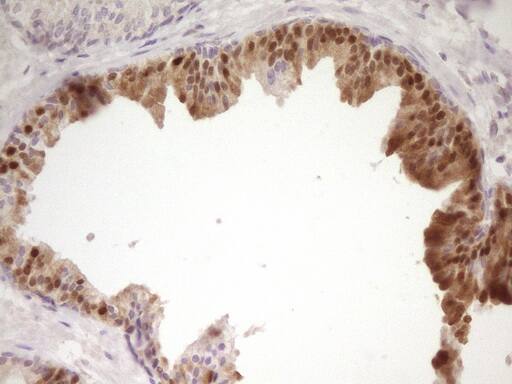 Immunohistochemical staining of paraffin-embedded Carcinoma of Human prostate tissue using anti-PAPSS2 mouse monoclonal antibody. Heat-induced epitope retrieval by EDTA solution buffer pH 8.0 at 120Â°C for 3 min.