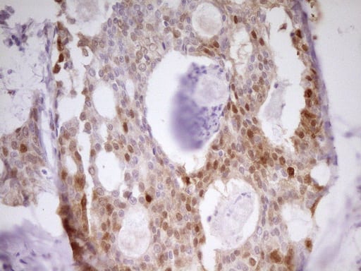 Immunohistochemical staining of paraffin-embedded Adenocarcinoma of Human breast tissue using anti-PAPSS2 mouse monoclonal antibody. Heat-induced epitope retrieval by EDTA solution buffer pH 8.0 at 120Â°C for 3 min.