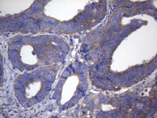 Immunohistochemical staining of paraffin-embedded Adenocarcinoma of Human colon tissue using anti-CYTH2 mouse monoclonal antibody. Heat-induced epitope retrieval by EDTA solution buffer pH 8.0 at 120Â°C for 3 min.