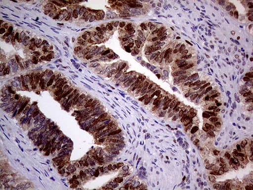 Immunohistochemical staining of paraffin-embedded Adenocarcinoma of Human endometrium tissue using anti-MAGEB4 mouse monoclonal antibody. Heat-induced epitope retrieval by EDTA solution buffer pH 8.0 at 120Â°C for 3 min.