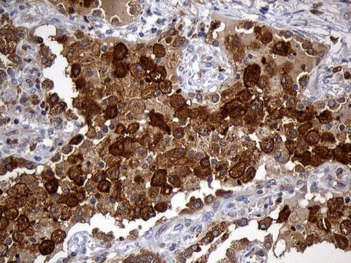 Immunohistochemical staining of paraffin-embedded Carcinoma of Human lung tissue using anti-GRB7 mouse monoclonal antibody. Heat-induced epitope retrieval by EDTA solution buffer pH 8.0 at 120Â°C for 3 min.